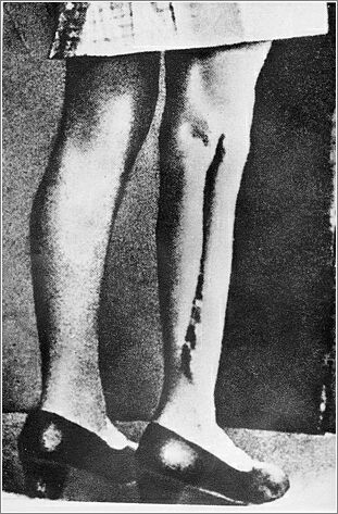 Ravensbruck, Germany, Scars on a leg of a woman after medical experiments